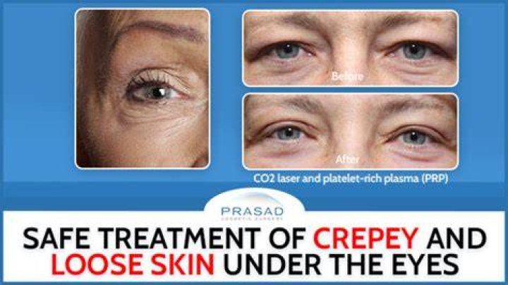 What is the best treatment for Crepey eyes?