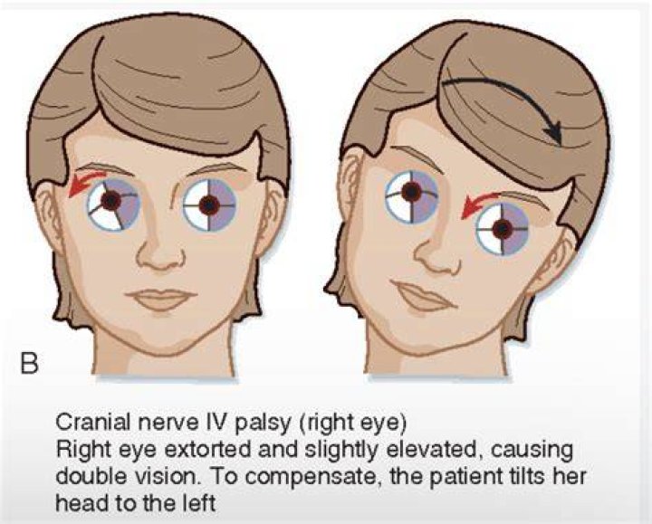 What would suggest a fourth nerve disease?